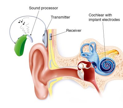 image showing cochlear implant and the inner ear